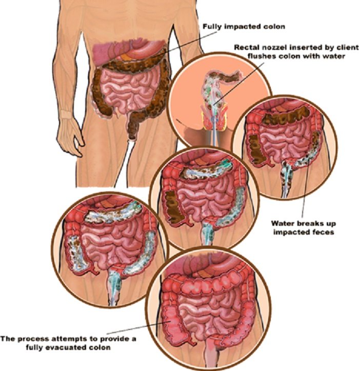 What is Colon Hydrotherapy?